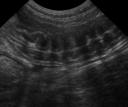 Corrugated small intestine