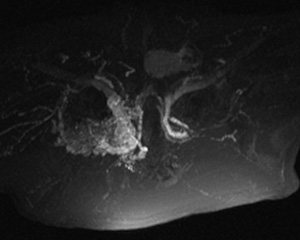 MR angiogram